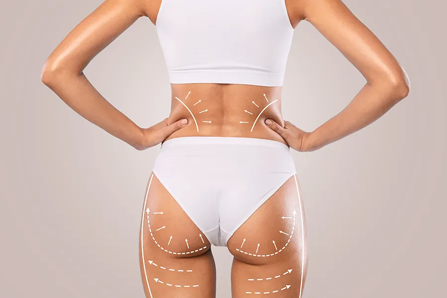 A woman with white lines on her butt and surrounding areas representing where a butt lift will be effective. Schedule Brazilian Butt Lift treatment from Dr. Hadi Michael Rassael at Millennium Wellness in Bethesda-Chevy Chase.