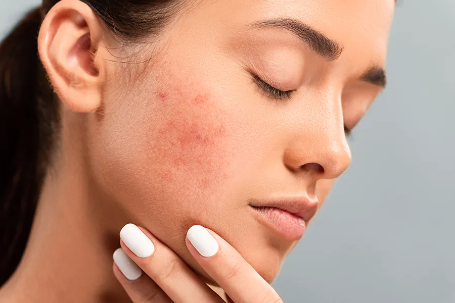 A woman touches acne on her face. Schedule CLEARLight Acne Treatment from Dr. Hadi Michael Rassael at Millennium Wellness in Bethesda-Chevy Chase.