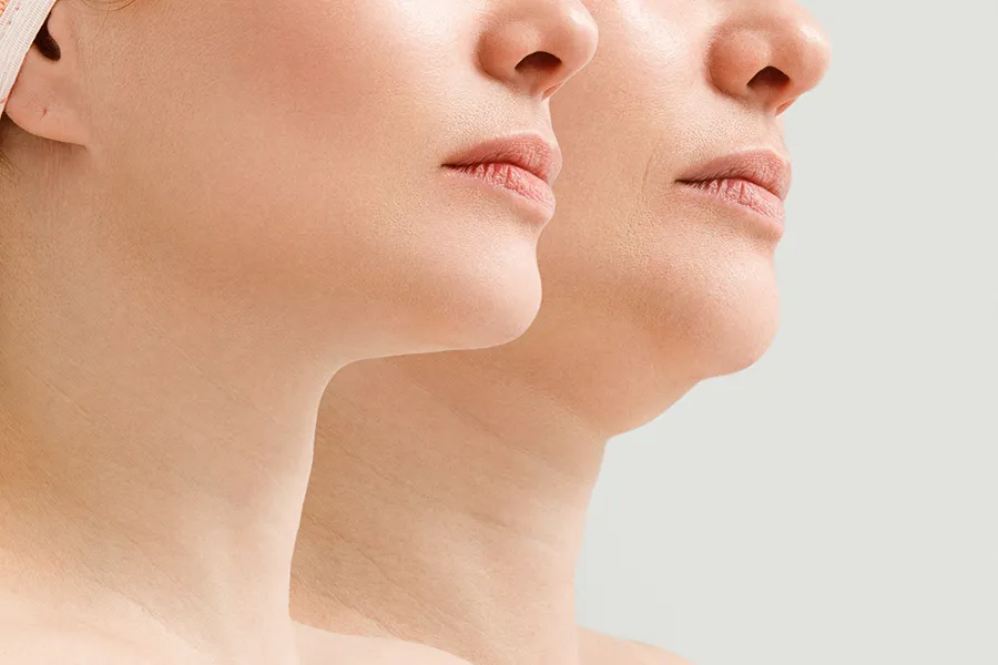 An image of a woman with a double chin and without. Get facial liposuction from Dr. Hadi Michael Rassael at Millennium Wellness in Bethesda-Chevy Chase.
